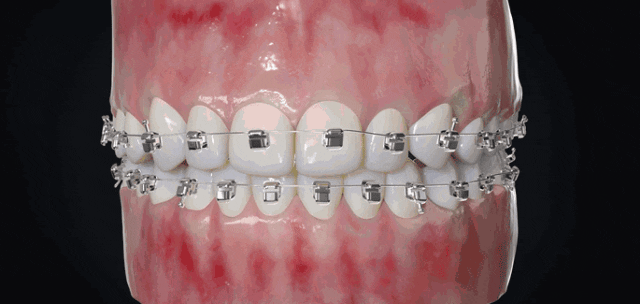 thumbnail image 2 of Morelli Orthodontic Self-Ligating Full Archwire Kit – Patient Case – 20 Archwires 2 of 6